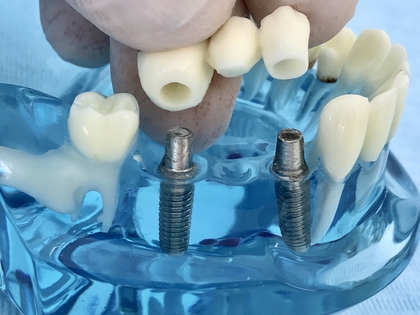 Zahnklinik für Implantologie, Implantat, Zahnimplantat und Oralchirurgie (2)