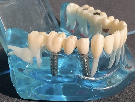 Zahnklinik für Implantologie, Implantat, Zahnimplantat und Oralchirurgie
